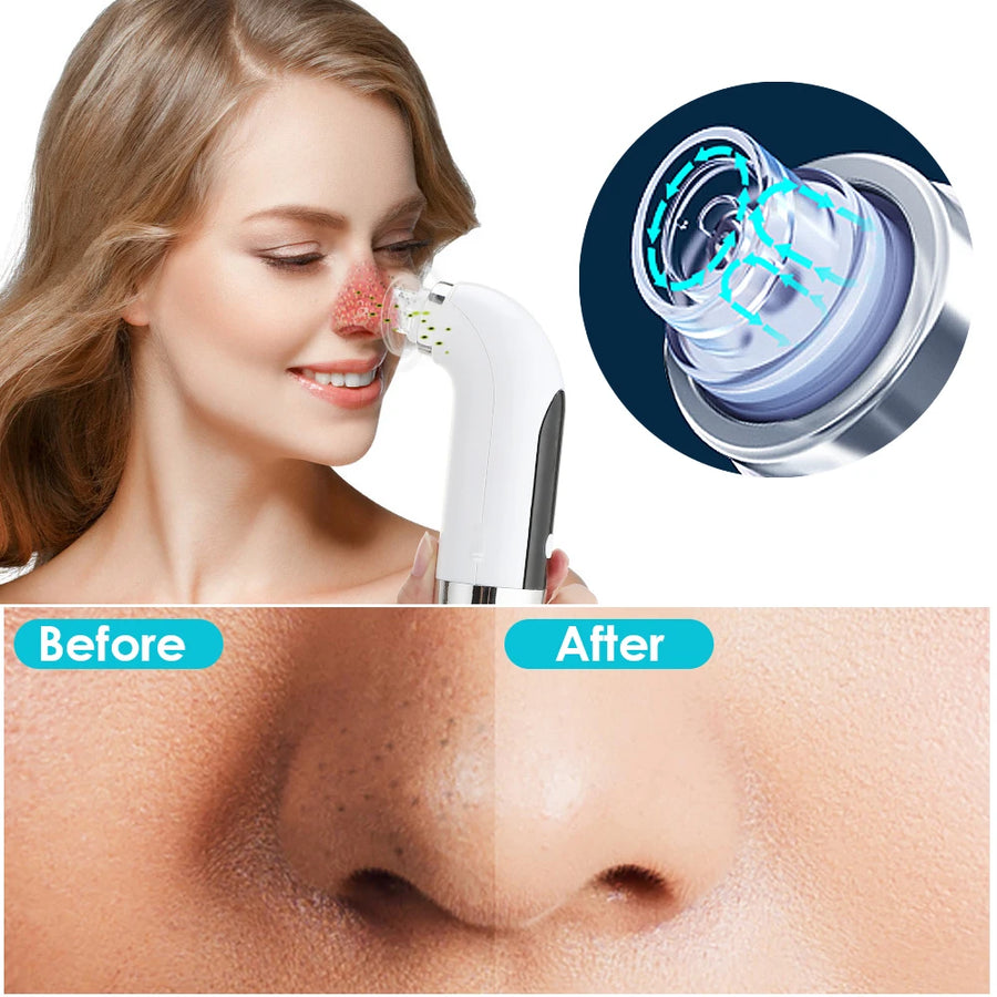 HilloNewskin - Bubble Pore Remover